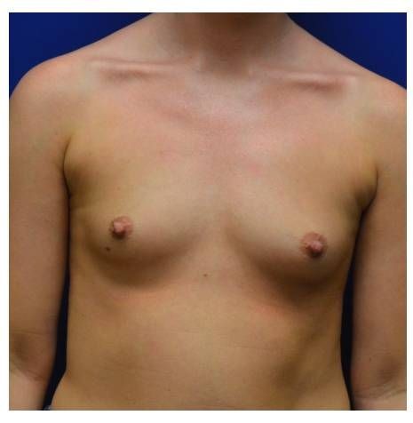 Breast Augmentation before and after - before
