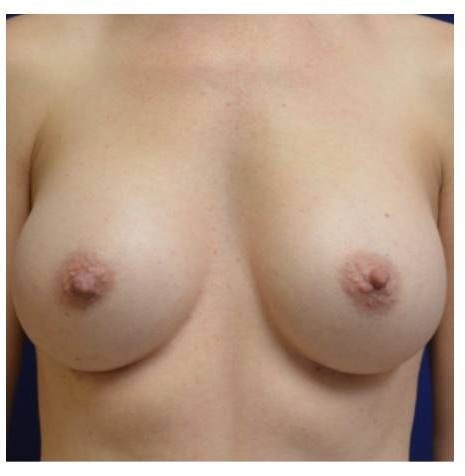 Breast Augmentation before and after - after
