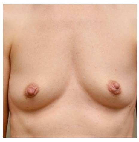 Breast Augmentation before and after - before