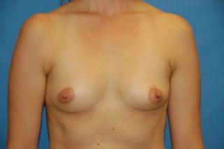 Breast Augmentation before and after - before