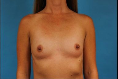 Breast Augmentation before and after - before