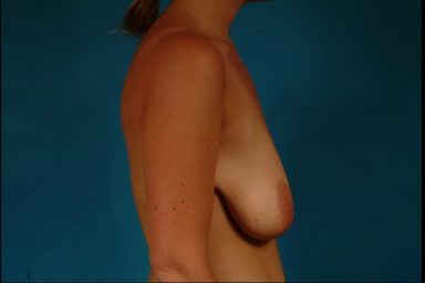 Breast Lift before and after - before