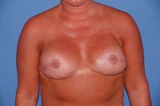 Breast Reconstruction after — Dr. George Rhodes