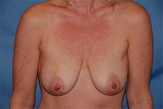 Breast Reconstruction before — Dr. George Rhodes