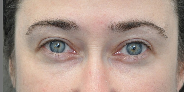 Upper Blepharoplasty before and after - after
