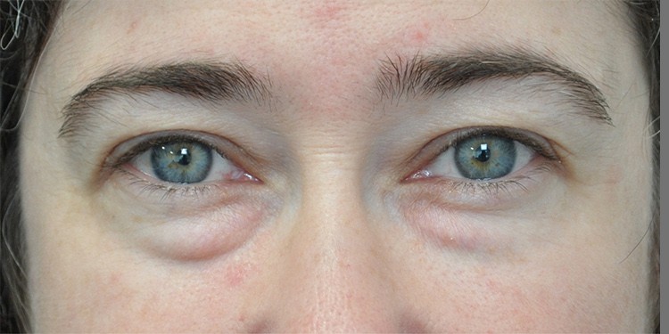 Upper Blepharoplasty before and after - before