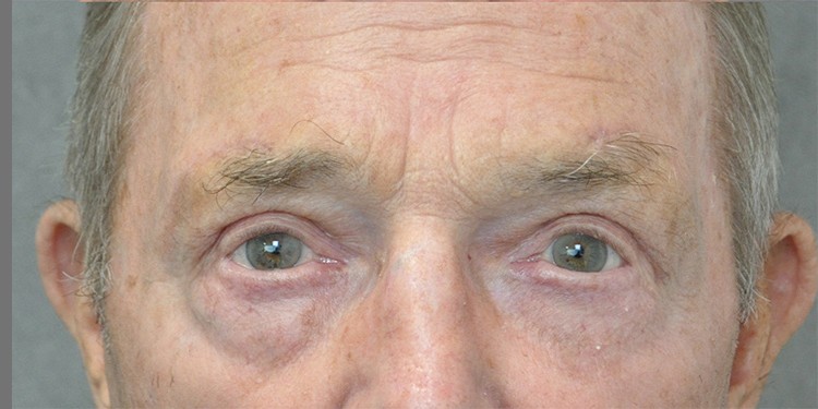 Upper Blepharoplasty before and after - after