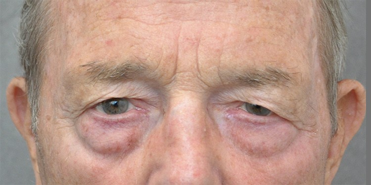 Upper Blepharoplasty before and after - before
