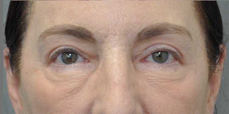 Blepharoplasty (Lower Eyelid) before and after - after