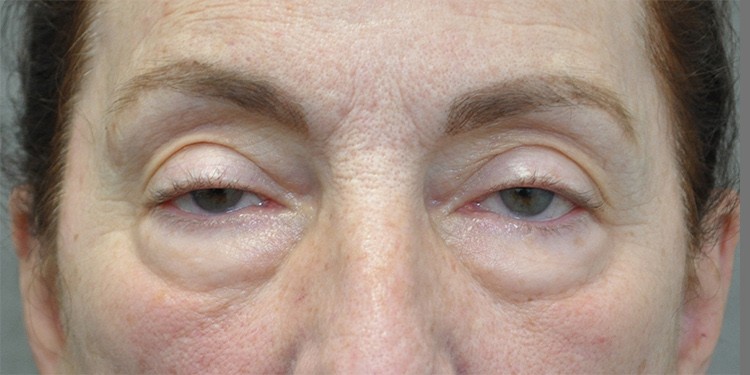 Blepharoplasty (Lower Eyelid) before and after - before