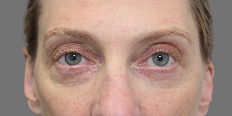 Blepharoplasty (Lower Eyelid) before and after - after