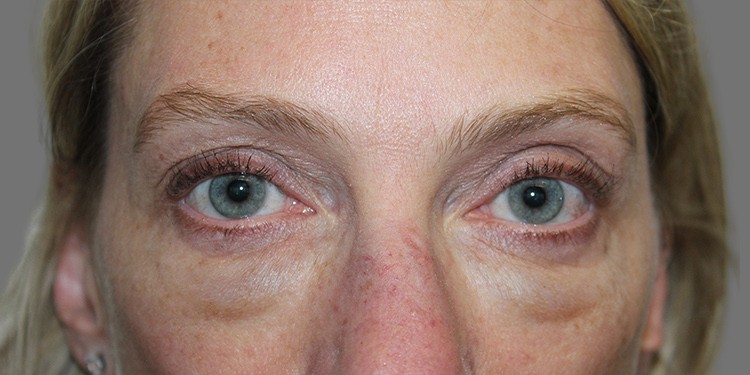 Blepharoplasty (Lower Eyelid) before and after - before