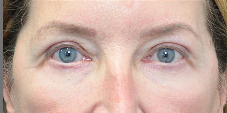 Blepharoplasty (Lower Eyelid) before and after - after