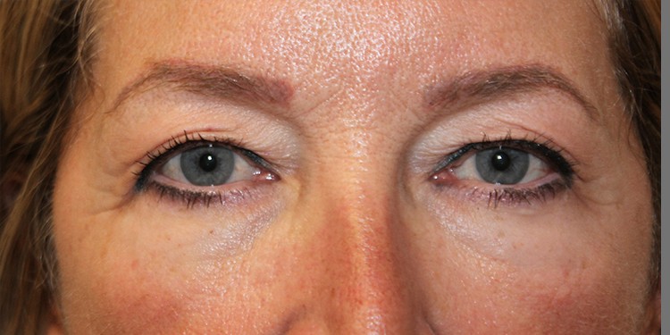 Blepharoplasty (Lower Eyelid) before and after - before