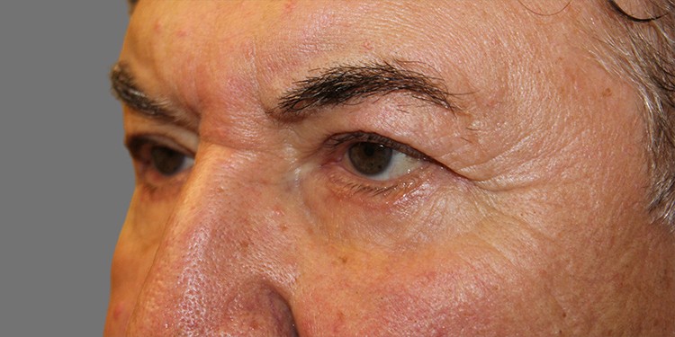 Blepharoplasty (Lower Eyelid) before and after - after