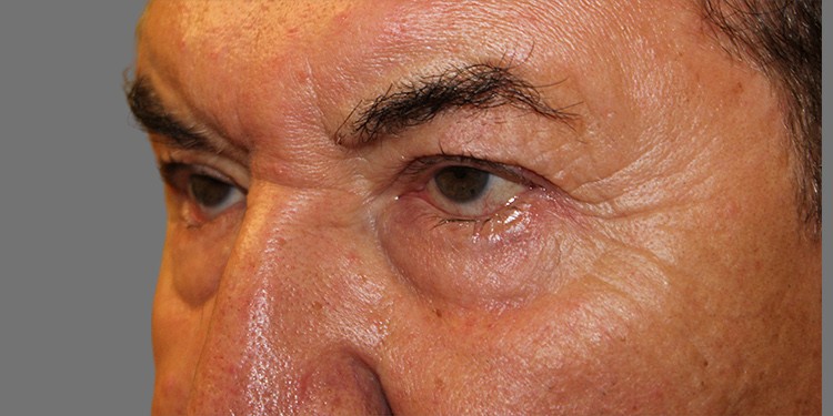 Blepharoplasty (Lower Eyelid) before and after - before