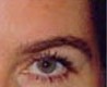 Blepharoplasty before and after - after