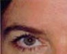 Blepharoplasty before and after - before