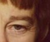 Blepharoplasty before and after - after