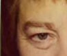 Blepharoplasty before and after - before