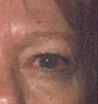 Blepharoplasty before and after - after