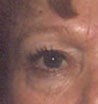 Blepharoplasty before and after - before