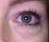 Blepharoplasty before and after - after