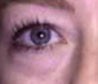 Blepharoplasty before and after - before