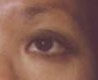 Blepharoplasty before and after - after