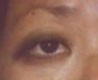 Blepharoplasty before and after - before