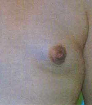 Breast Augmentation before and after - after