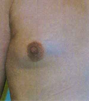 Breast Augmentation before and after - before