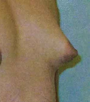 Breast Augmentation before and after - after