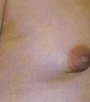 Breast Augmentation before and after - before