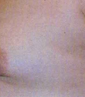 Breast Augmentation before and after - after
