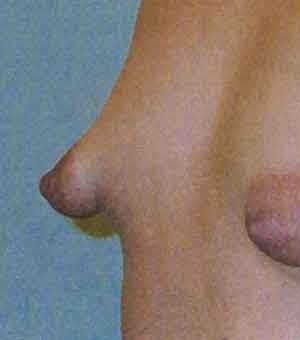 Breast Augmentation before and after - before