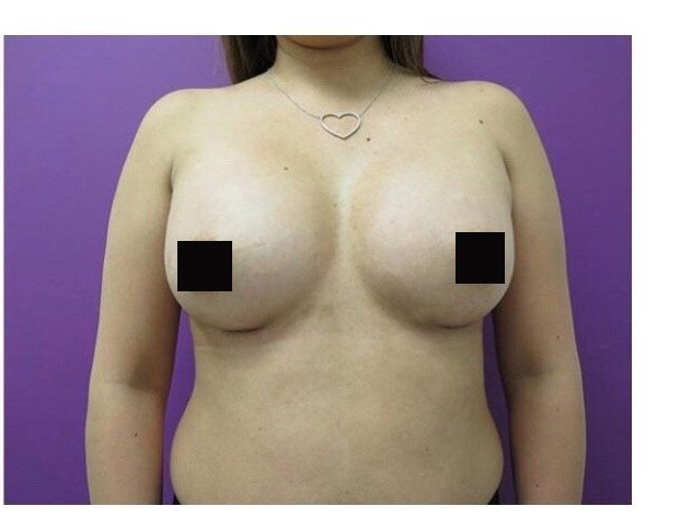 Breast Augmentation before and after - after
