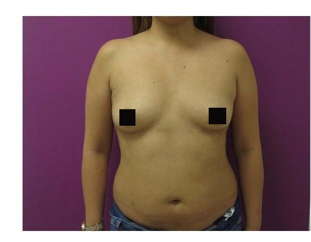 Breast Augmentation before and after - before