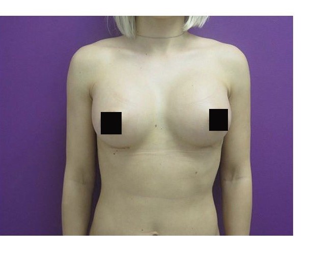 Breast Augmentation before and after - after