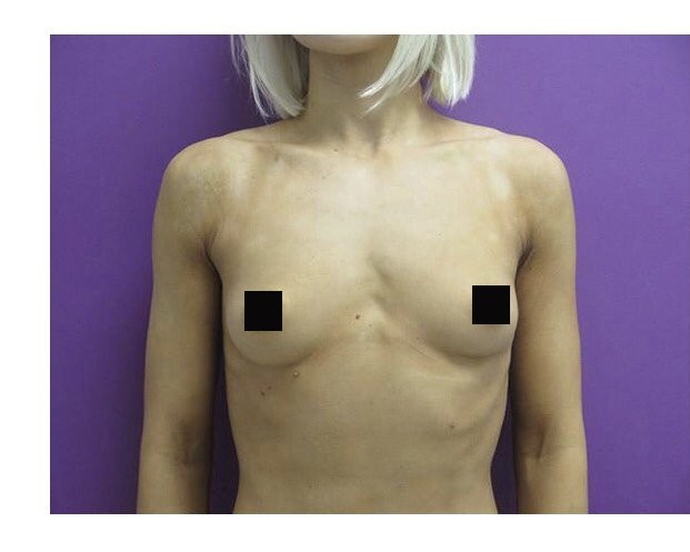 Breast Augmentation before and after - before