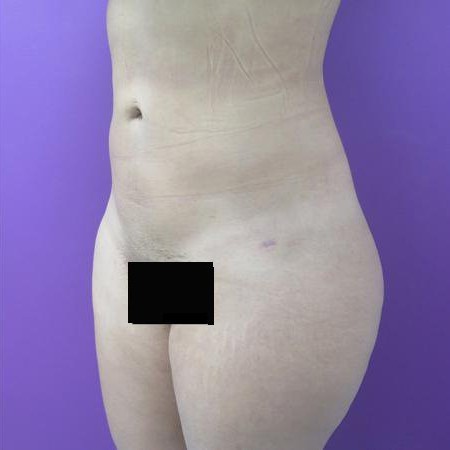 Liposuction before and after - after