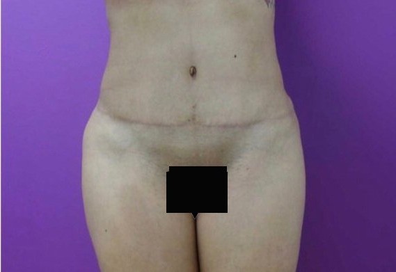 Tummy Tuck before and after - after