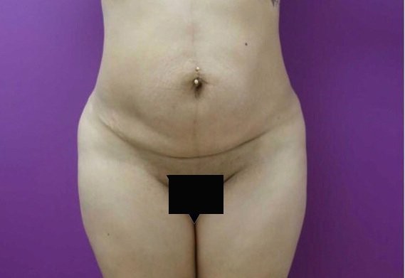 Tummy Tuck before and after - before