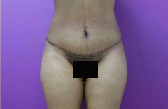 Tummy Tuck before and after - after