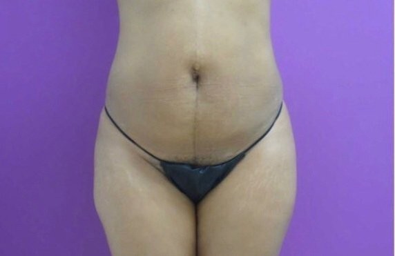 Tummy Tuck before and after - before