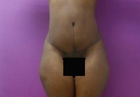 Tummy Tuck before and after - after
