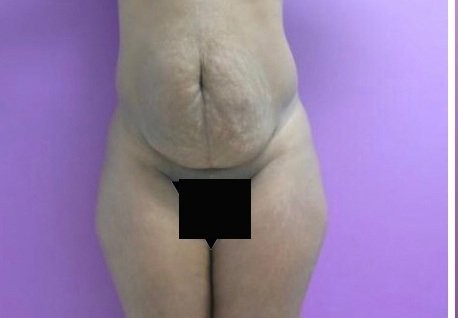 Tummy Tuck before and after - before