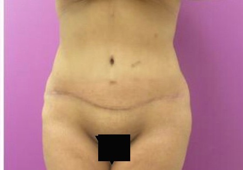 Tummy Tuck before and after - after