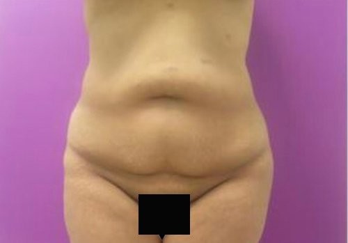 Tummy Tuck before and after - before