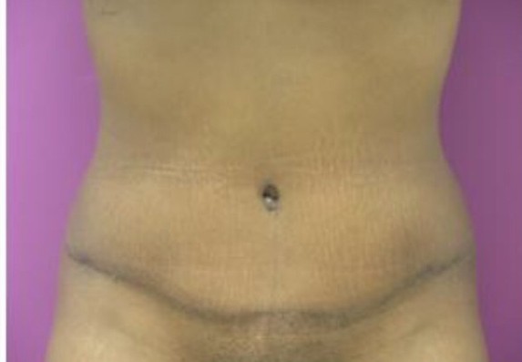 Tummy Tuck before and after - after